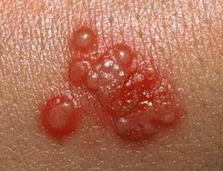 Illustration for article titled cara mengatasi penyakit herpes secara alami ampuh tanpa efek samping
